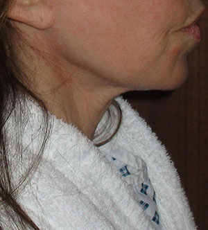 Before a necklift procedure with Dr Dirk Kremer 2